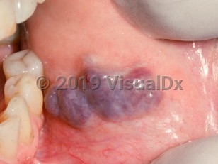 Clinical image of Oral hemangioma - imageId=2505948. Click to open in gallery.  caption: 'Confluent violaceous nodules on the buccal mucosa.'