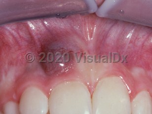 Clinical image of Peripheral giant cell granuloma - imageId=2506339. Click to open in gallery.  caption: 'A sessile reddish-purple, dusky nodule with overlying prominent telangiectasias on the gingiva.'