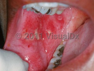 Clinical image of Chemotherapy-induced mucositis - imageId=2512895. Click to open in gallery.  caption: 'Extensive slough-covered erosions on the buccal mucosa.'