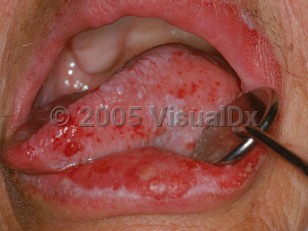 Clinical image of Proliferative verrucous leukoplakia - imageId=2517899. Click to open in gallery.  caption: 'White, verrucous, and rugose papules with intervening red stippling and papules on the tongue. Note also the red and white crusted plaque on the lower lip.'