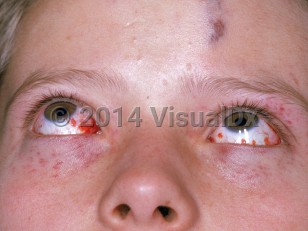 Clinical image of Bacterial meningitis - imageId=2523135. Click to open in gallery. 