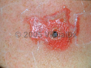 Clinical image of Vaccination bacterial infection - imageId=2539650. Click to open in gallery. 
