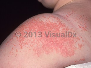 Clinical image of Xanthoma disseminatum - imageId=2546740. Click to open in gallery.  caption: 'Multiple thin orange-red papules, coalescing to form plaques on the shoulder, arm, and upper back.'