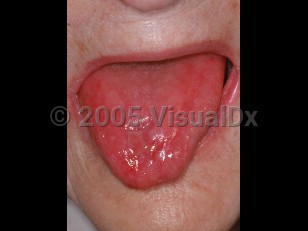 Clinical image of Plummer-Vinson syndrome - imageId=2555260. Click to open in gallery.  caption: 'Marked atrophy of lingual papillae producing a smooth, red appearance to the tongue with an erosion on the distal tongue.'