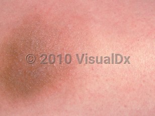 Clinical image of Vitamin K injection site reaction - imageId=2574632. Click to open in gallery.  caption: 'A close-up of a pink and light brown plaque with overlying tiny papules, 2 months after a vitamin K injection.'