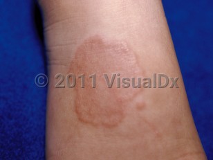 Clinical image of Granuloma annulare - imageId=25856. Click to open in gallery.  caption: 'Annular, orange-red, smooth plaque on the dorsal hand.'