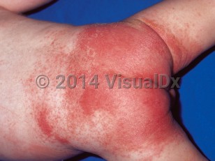 Clinical image of Diaper irritant contact dermatitis - imageId=264348. Click to open in gallery.  caption: 'Diffuse, brightly erythematous papules and plaques on the buttocks, lower back, and upper thighs.'