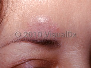 Clinical image of Foreign body granuloma - imageId=2699332. Click to open in gallery.  caption: 'A faintly violaceous plaque with overlying telangiectasias on the lower forehead (silicone granuloma).'