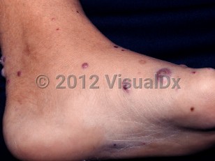 Clinical image of Perforating folliculitis - imageId=2703842. Click to open in gallery. 