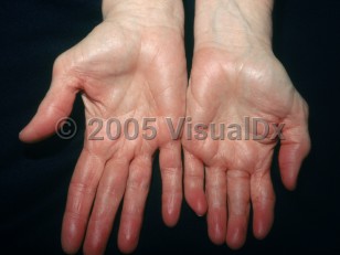Clinical image of Erythromelalgia - imageId=2704003. Click to open in gallery.  caption: 'Deep red erythema of the distal digits.'