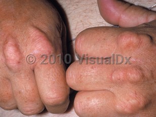 Clinical image of Xanthoma tendinosum - imageId=272063. Click to open in gallery.  caption: 'Skin-colored and yellowish nodules over the knuckles.'