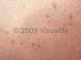 Clinical image of Typhoid fever - imageId=2721479. Click to open in gallery. 