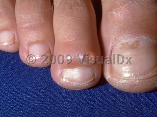 Clinical image of Myxoid cyst - imageId=272604. Click to open in gallery.  caption: 'A translucent papule on the distal toe.'