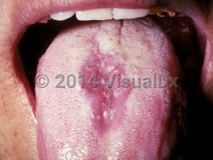 Clinical image of Median rhomboid glossitis - imageId=273225. Click to open in gallery.  caption: 'A smooth red patch with overlying white flecks on the central dorsal tongue.'