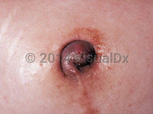 Clinical image of Cutaneous endometriosis - imageId=273500. Click to open in gallery.  caption: 'A pink and grayish nodule in the umbilicus.'