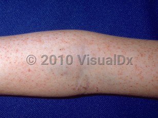 Clinical image of Rocky Mountain spotted fever - imageId=273650. Click to open in gallery.  caption: 'Myriad petechiae on the arm.'