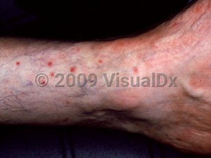 Clinical image of Chigger bite - imageId=2737472. Click to open in gallery.  caption: 'Numerous crusted erythematous papules around the lower leg and ankle.'