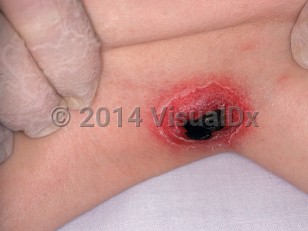 Clinical image of Neonatal bacterial sepsis - imageId=2749439. Click to open in gallery. 