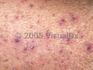 Clinical image of Scurvy - imageId=2760850. Click to open in gallery.  caption: 'A close-up of scattered perifollicular purpura and "corkscrew" hairs.'