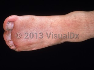 Clinical image of Apert syndrome - imageId=2763659. Click to open in gallery. 