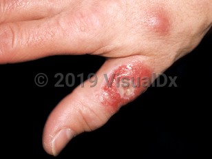 Clinical image of Mycobacterium marinum infection - imageId=276636. Click to open in gallery.  caption: 'An ulcerated, bright red nodule on the thumb and a nearby smooth, pink papule, on the dorsal hand.'