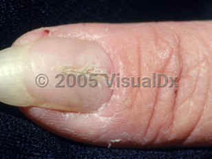 Clinical image of Median nail dystrophy - imageId=2789155. Click to open in gallery.  caption: 'A midline longitudinal split, starting at the cuticle and growing toward the free edge of the nail with a few short, chevron-shaped cracks that extend laterally from the split, giving the appearance of an "inverted fir tree." There is also an enlarged lunula.'
