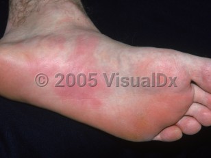 Clinical image of Pressure urticaria - imageId=2790876. Click to open in gallery. 