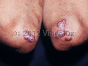 Clinical image of Erythema elevatum diutinum - imageId=2791492. Click to open in gallery.  caption: 'Substantive violaceous scaly and crusted papules and plaques on the elbows and associated post-inflammatory hyperpigmentation.'