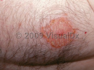 Clinical image of Nipple dermatitis - imageId=2792768. Click to open in gallery.  caption: 'A scaly and crusted plaque on the nipple and areola.'