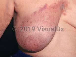 Clinical image of Cutaneous presentations of breast cancer - imageId=2803850. Click to open in gallery. 