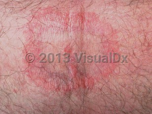 Clinical image of Lyme disease - imageId=280584. Click to open in gallery.  caption: 'A thin erythematous, annular plaque with a central thin erythematous papule.'