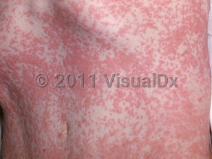 Clinical image of Exanthematous drug eruption - imageId=2811647. Click to open in gallery.  caption: 'Widespread erythematous papules and plaques on the abdomen.'