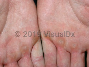 Clinical image of Callus - imageId=2828938. Click to open in gallery.  caption: 'Thickly keratotic papules on the distal palms.'