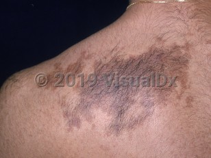 Clinical image of Becker nevus - imageId=2834883. Click to open in gallery.  caption: 'A large, brown patch with associated hypertrichosis and outlying smaller patches on the back.'