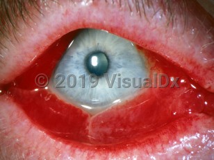 Clinical image of Acute hemorrhagic conjunctivitis - imageId=2842429. Click to open in gallery.  caption: 'Extensive conjunctival hemorrhage.'