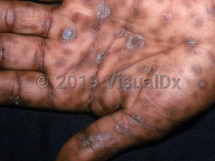 Clinical image of Secondary syphilis - imageId=2848052. Click to open in gallery.  caption: 'Multiple brown papules and small plaques, some with overlying thick scales and others with collarettes, on the palm.'