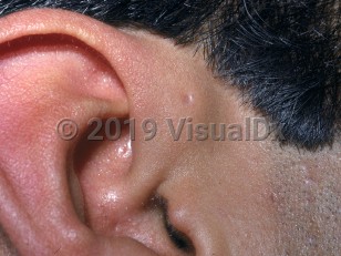 Clinical image of Preauricular sinus - imageId=2850403. Click to open in gallery.  caption: 'A tiny pit near the crus of the helix.'