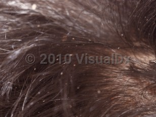 Clinical image of Pediculosis capitis - imageId=2850527. Click to open in gallery.  caption: 'A close-up of nits along hair shafts on the scalp hair.'