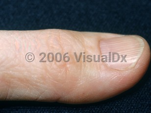Clinical image of Longitudinal nail ridging - imageId=2882816. Click to open in gallery. 