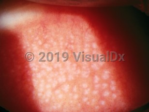 Clinical image of Giant papillary conjunctivitis - imageId=2893823. Click to open in gallery.  caption: 'Myriad faint pink-white papules (papillae) on the pretarsal conjunctiva of the upper eyelid.'