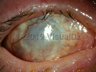 Clinical image of Phthisis bulbi - imageId=2902236. Click to open in gallery. 