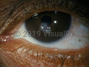 Clinical image of Distichiasis - imageId=2903865. Click to open in gallery.  caption: 'Tiny hairs arising from meibomian gland openings on the eyelid margin.'