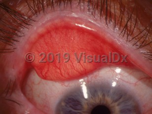 Clinical image of Floppy eyelid syndrome - imageId=2905591. Click to open in gallery. 