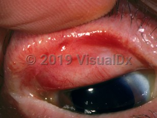 Clinical image of Cicatricial conjunctivitis - imageId=2906310. Click to open in gallery. 