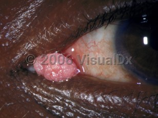 Clinical image of Conjunctival papilloma - imageId=2912647. Click to open in gallery. 
