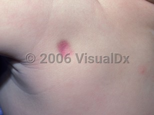Clinical image of Medical procedure injury in utero - imageId=2929780. Click to open in gallery. 
