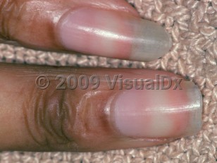 Clinical image of Nail changes of chronic renal failure - imageId=2930036. Click to open in gallery.  caption: 'Half and half nails.'