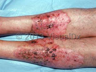 Clinical image of Bowel-associated dermatosis-arthritis syndrome - imageId=2932284. Click to open in gallery.  caption: 'Large eroded and crusted plaques on the shins, appearing after bariatric surgery.'