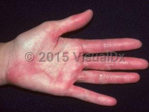 Clinical image of Toxic shock syndrome - imageId=2937697. Click to open in gallery.  caption: 'Deep red shiny patches and plaques on the palm and fingers.'