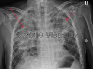 Imaging Studies image of Herpes simplex virus pneumonia - imageId=2953740. Click to open in gallery.  caption: 'Frontal chest x-ray with bilateral air space consolidation, right lobe, (long red arrow), greater than left, (short red arrow).'